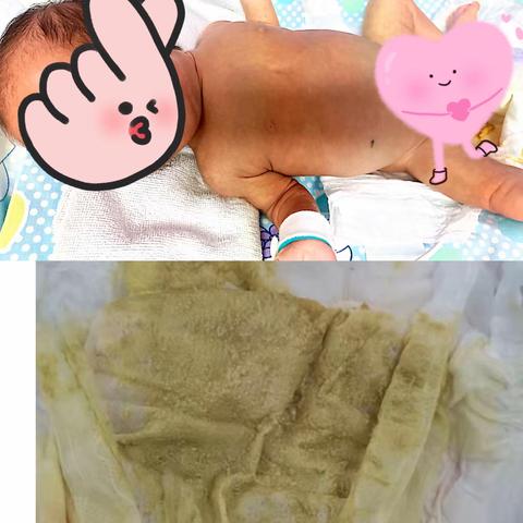 早产儿胆汁淤积—多学科联合妙手仁心成功救治