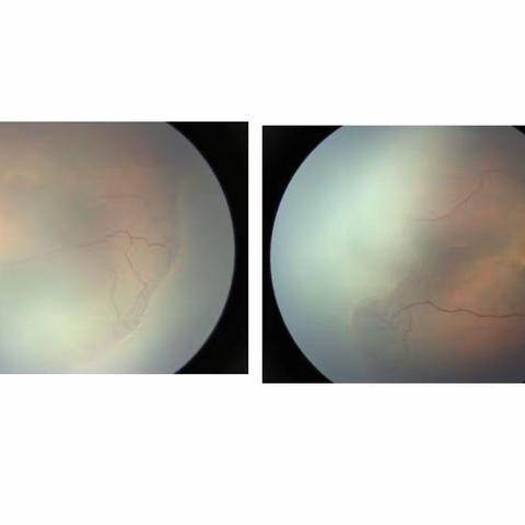 ROP患儿的福音-我院成功实施首例早产儿视网膜病变玻璃体腔注药术