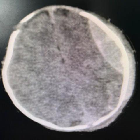 通过头颅血肿穿刺抽血成功治疗1例硬膜外血肿患儿