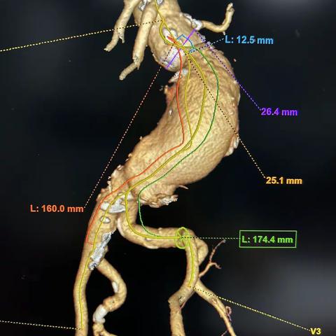 83Y M高危短瘤颈腹主动脉瘤