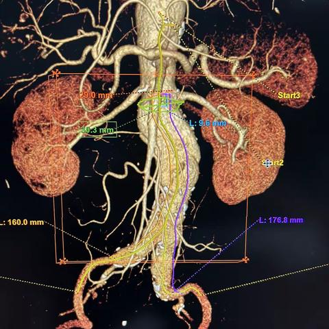 重建单侧肾动脉精准铆钉近肾腹主动脉瘤