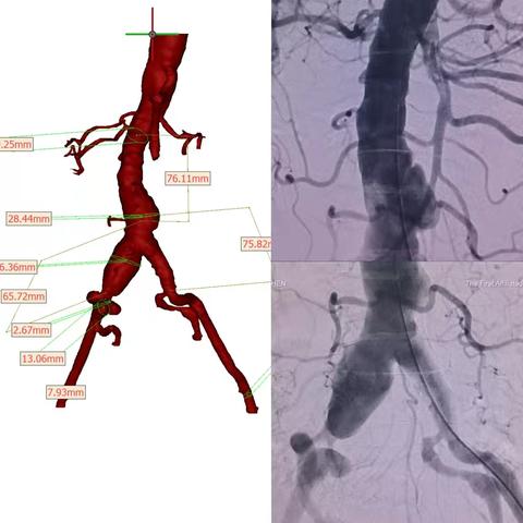 现代化图像融合指导腹主动脉支架植入