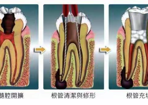 【健康科普】——根管治疗是什么？