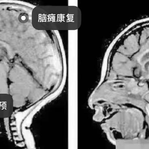 小头畸形—如何康复治疗