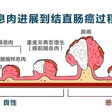 胃息肉的分类及癌变风险