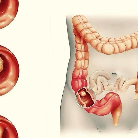 肠息肉的癌变风险及防治