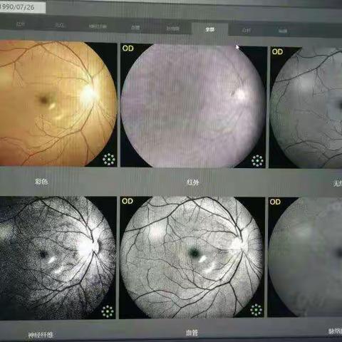 您身边的眼部彩色照相机:免散瞳眼底照相仪——海口市第四人民医院引进
