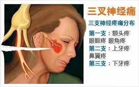 洛宁县老百姓福音，三叉神经痛患者无需外地就医，洛宁县人民医院神经外科开展“三叉神经痛显微血管减压术”