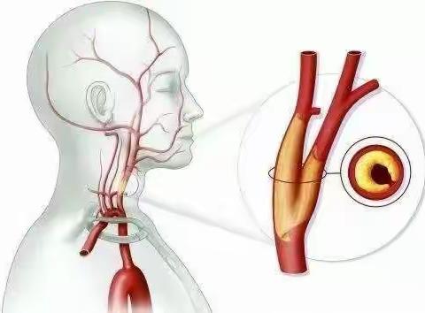 洛宁县人民医院卒中中心成功开展高龄患者颈动脉内膜剥脱术