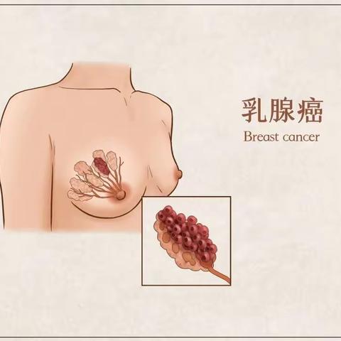 【健康科普】乳腺癌科普小知识
