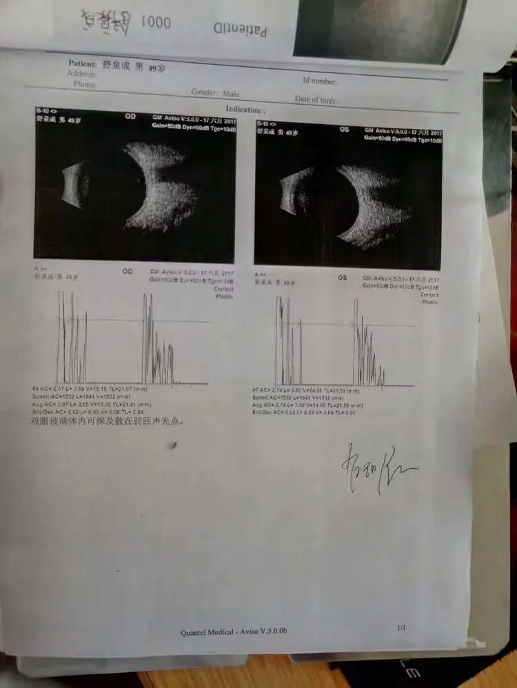 曲率性近视计算晶体度数求教