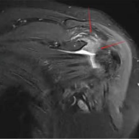 粘连性肩关节炎