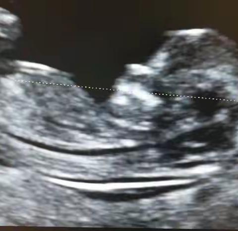 合水县人民医院彩超室开展胎儿早孕期产前筛查（NT检查）