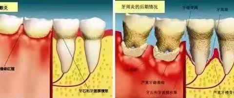 牙周炎十大症状，你中了几招