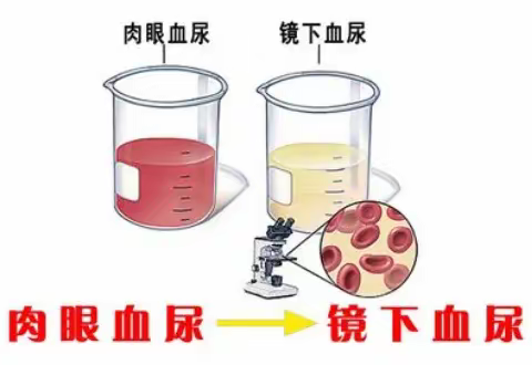 尿潜血阳性一定是血尿吗？