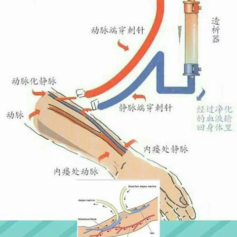 动静脉内瘘的日常护理