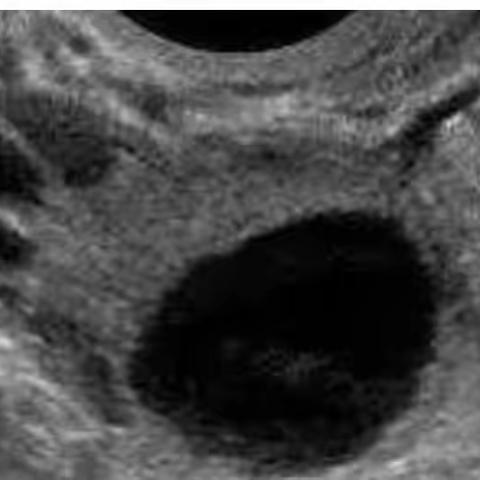 超声测排卵，什么时候做？