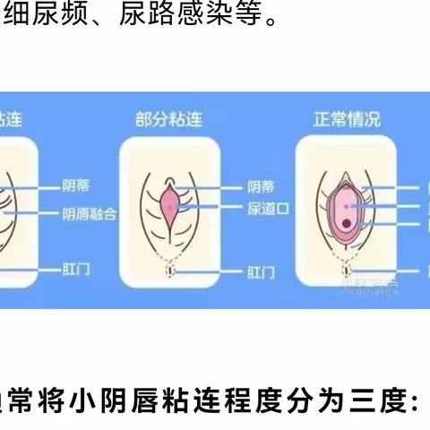 小阴唇粘连 小公主的难言之隐