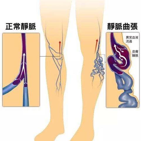 放血疗法治疗下肢静脉曲张