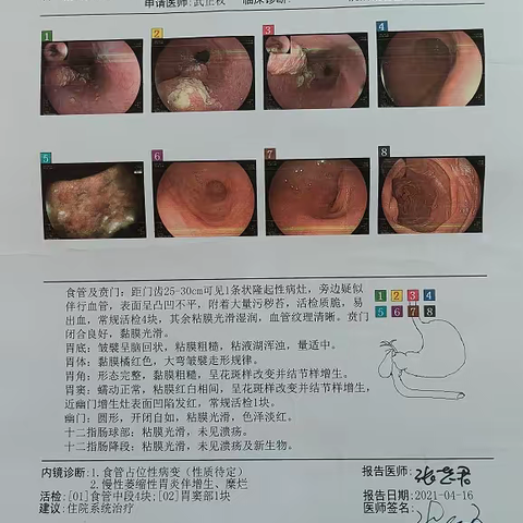 甘肃省中医院胸外科完成一例“食管中段及胃底双源癌同期根治术”