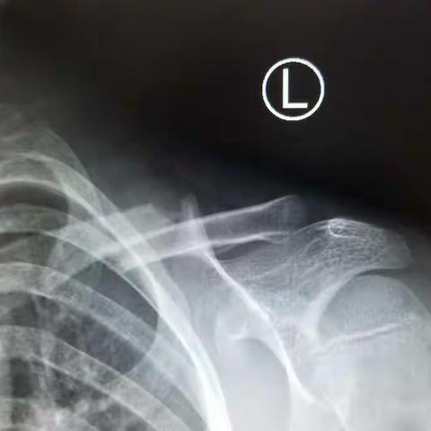 小儿锁骨骨折微创治疗：闭合复位经皮克氏针内固定术