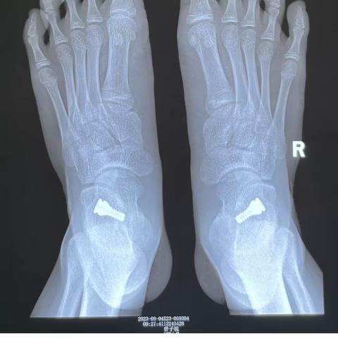 扁平足怎么办？