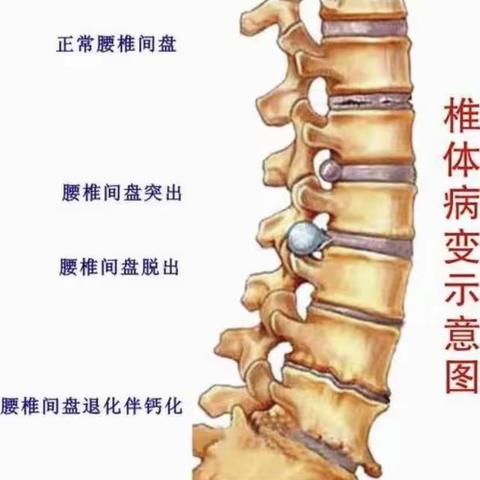 腰椎间盘突出