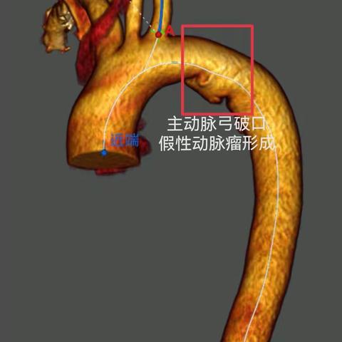 鄂尔多斯市中心医院胸心血管外科    《再次自主完成Castor一体式分支支架治疗外伤性主动脉破裂假性动脉瘤》