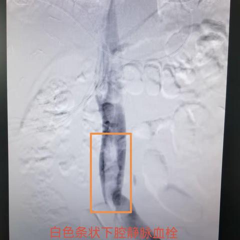 守护着我们的光— — 记取除下腔静脉滤器的那些事