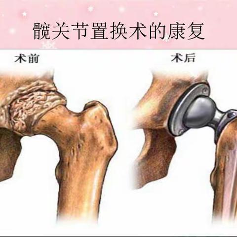 髋关节置换术后护理