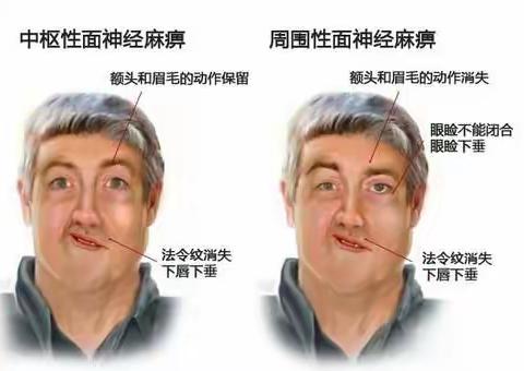 导致面瘫有什么原因呢？