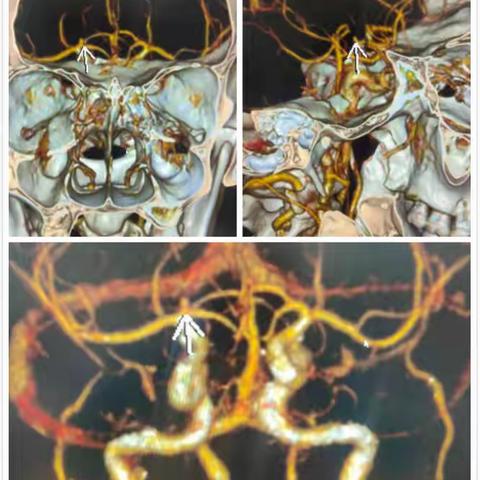 右侧大脑前动脉起始部动脉瘤球囊导管辅助栓塞1例