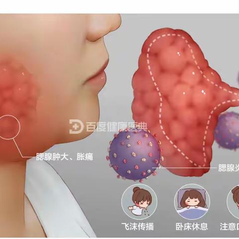 【未央教育·职教中心】疫情防控线上教学期间冬季传染病知识小课堂—第五课《流行性腮腺炎》