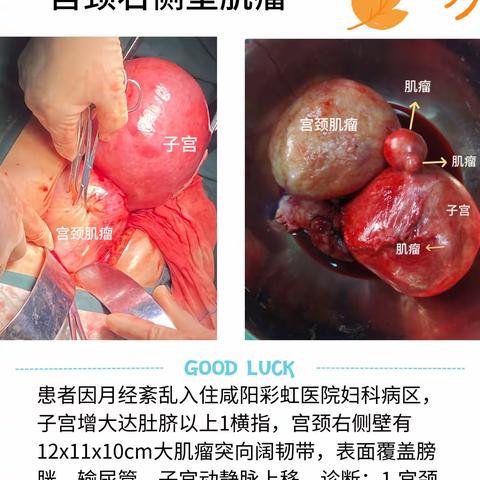 2023年9月妇科成功实施手术治疗，过程顺利，术后恢复好。