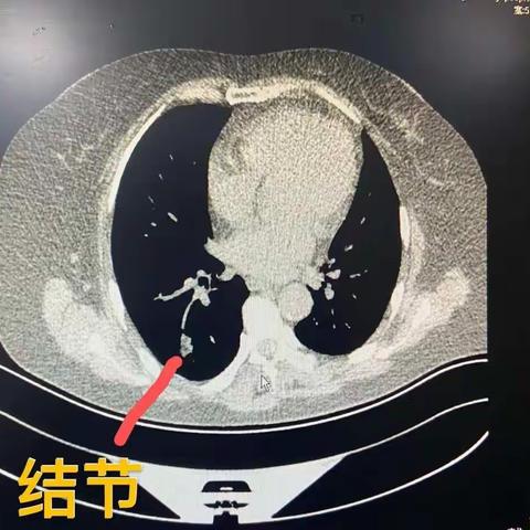 精准肺穿刺助早期肺癌患者临床治愈