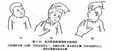 痉挛型常见异常姿势与家庭康复训练指导
