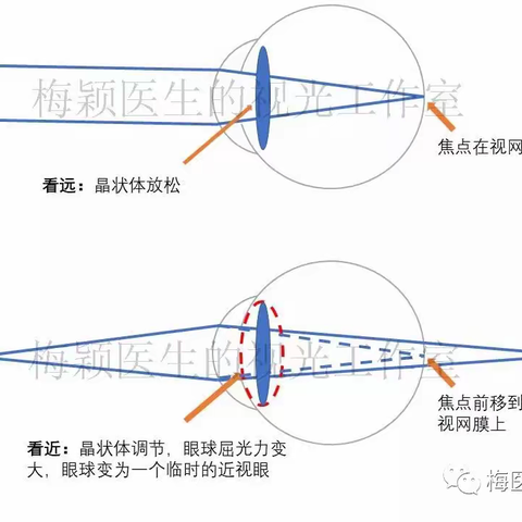 儿童近视了不戴镜会有什么后果？