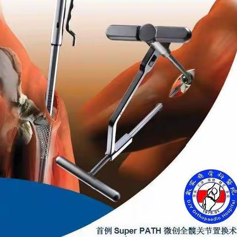 陆良戴家尧骨科医院SuperPATH微创髋关节置换术