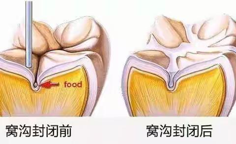 什么是窝沟封闭?