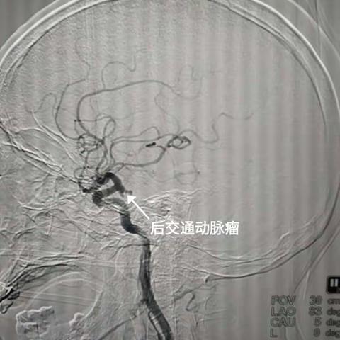 巧手摘除“颅内不定时炸弹”