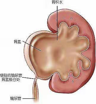 肾盂输尿管狭窄（UPJO）正偷走你的肾