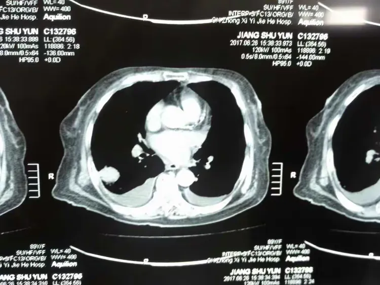 岳母肺部肿瘤病情演变