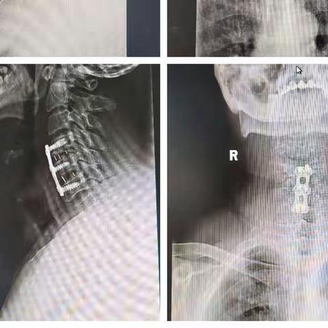 我院骨科成功为2名颈椎病患者进行手术