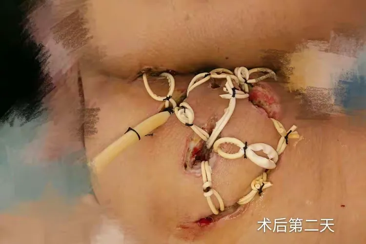 复杂性肛周脓肿病例分享