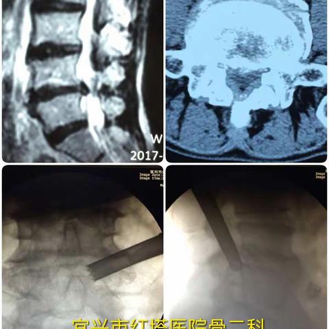 红塔医院骨二科完成100例椎间孔镜手术