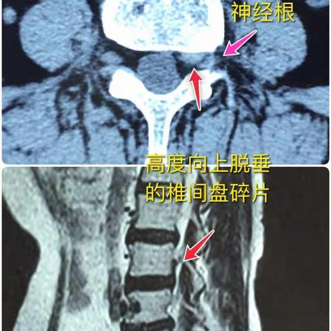 椎间孔镜微创手术完成一例高度向上脱垂的椎间盘突出