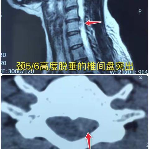 经皮脊柱内镜颈后路取出高度脱垂的颈椎间盘突出一例