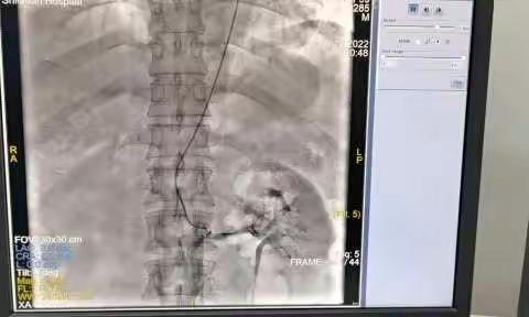 石泉县医院内一科：成功施行全县首例经肱动脉穿刺选择性双肾动脉造影术，为顽固性高血压患者带来福音