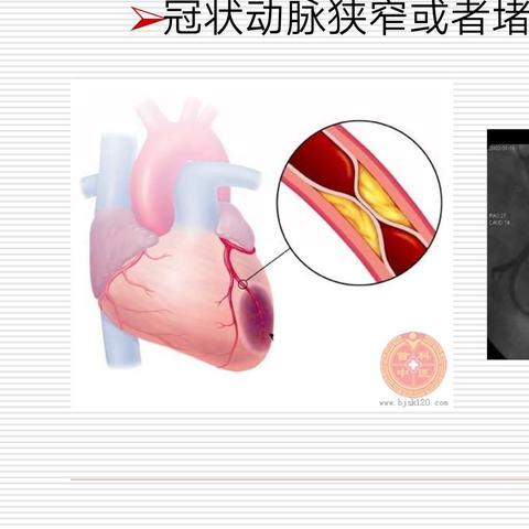 动脉粥样硬化是怎么回事了