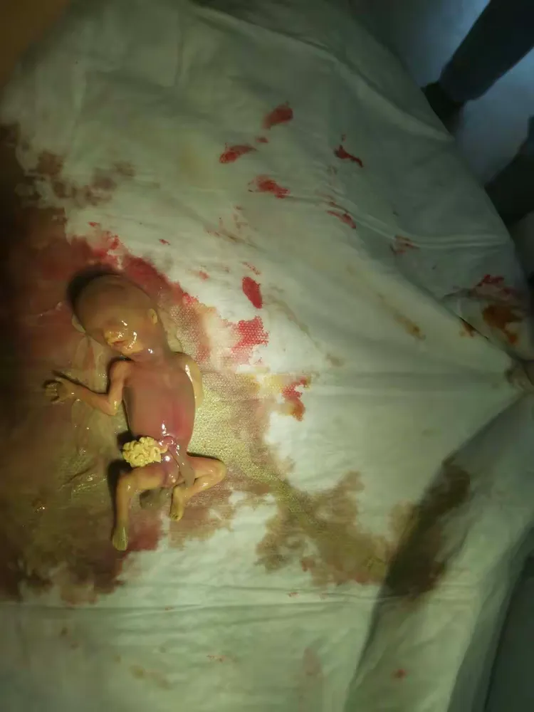 典型病例(胎儿腹裂)